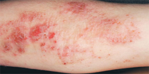Eczema Inside the arm